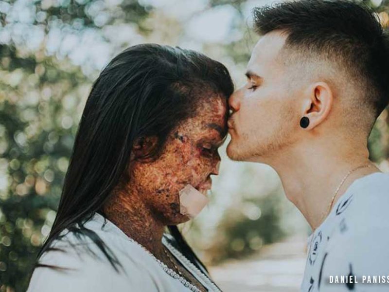 Hàng Triệu Người Được Khích Lệ Khi Người Nam Của Chúa Đính Hôn Ước Với Người Nữ Mắc Chứng Da Hoại Tử